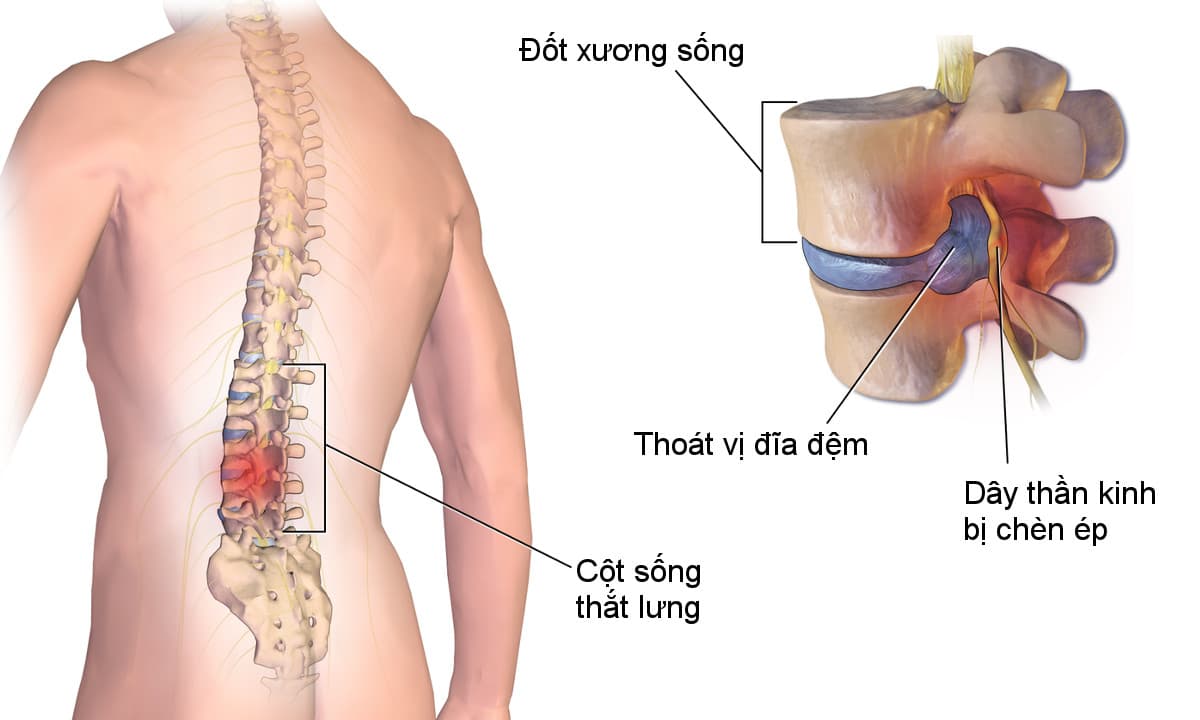 Nguyên nhân thoát vị đĩa đệm