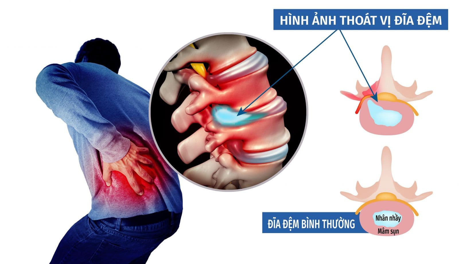 Thoát vị đĩa đệm l4 l5 có nguy hiểm không?