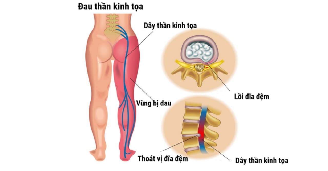 Triệu chứng thoát vị đĩa đệm l4 l5