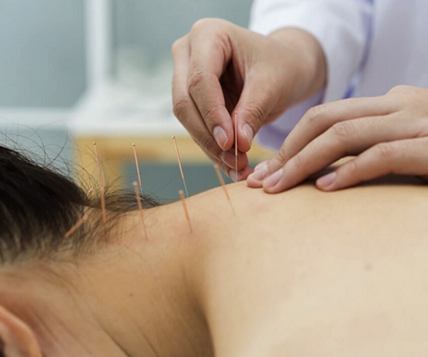 Đau cổ vai gáy có châm cứu được không?