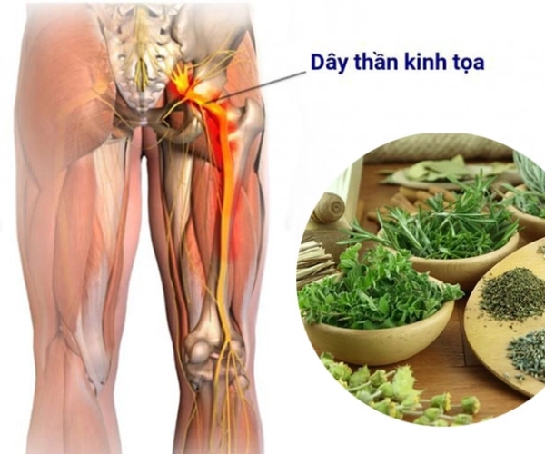 Cách chữa bệnh đau dây thần kinh tọa