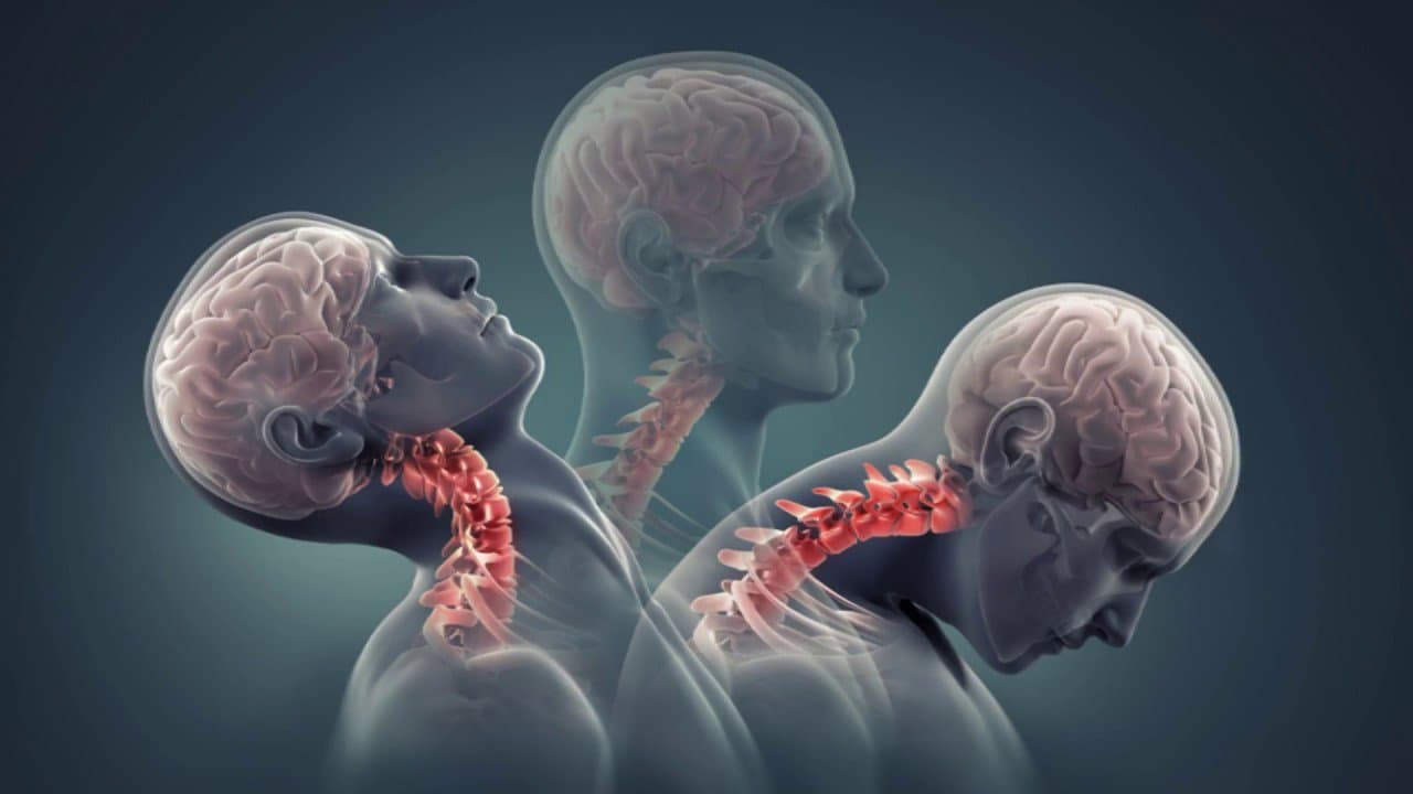 Triệu chứng thoái hóa đốt sống cổ