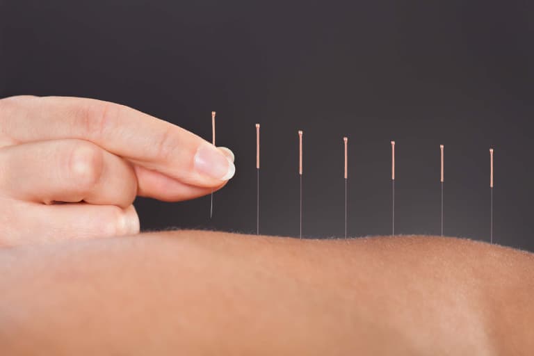 Điều trị thoát vị đĩa đệm ở mông bằng châm cứu
