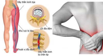 Nguyên nhân và dấu hiệu thoát vị đĩa đệm mông