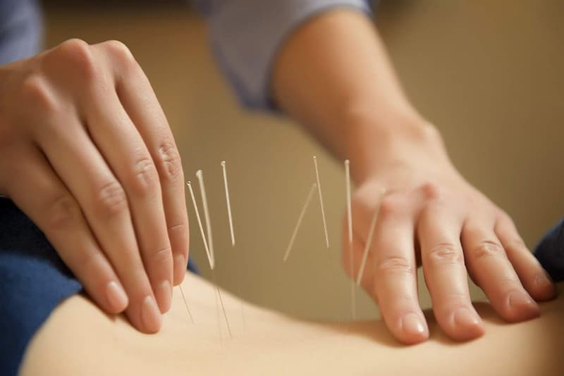 Đau dây thần kinh tọa có châm cứu được không?
