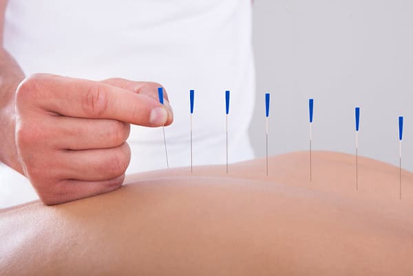 Phương pháp châm cứu chữa đau thần kinh