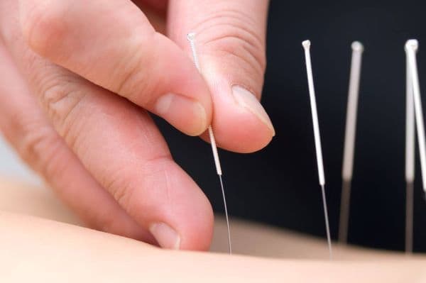 Điều trị đau thần kinh tọa bằng châm cứu kết hợp các phương pháp khác tại Khang Minh Đường