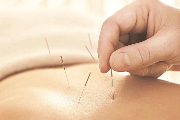 Châm cứu chữa đau thần kinh tọa