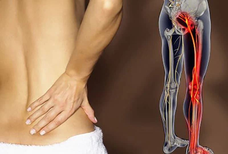 Đau thần kinh tọa là gì? Triệu chứng đau thần kinh tọa