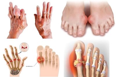 Bệnh gout là gì?