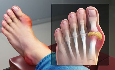 Bệnh gout thống phong là gì? 