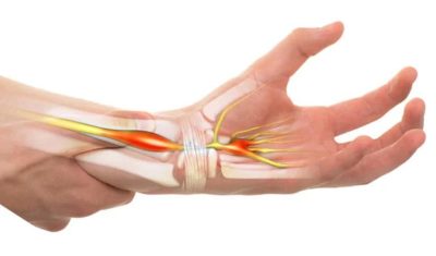 Viêm dây thần kinh cổ tay