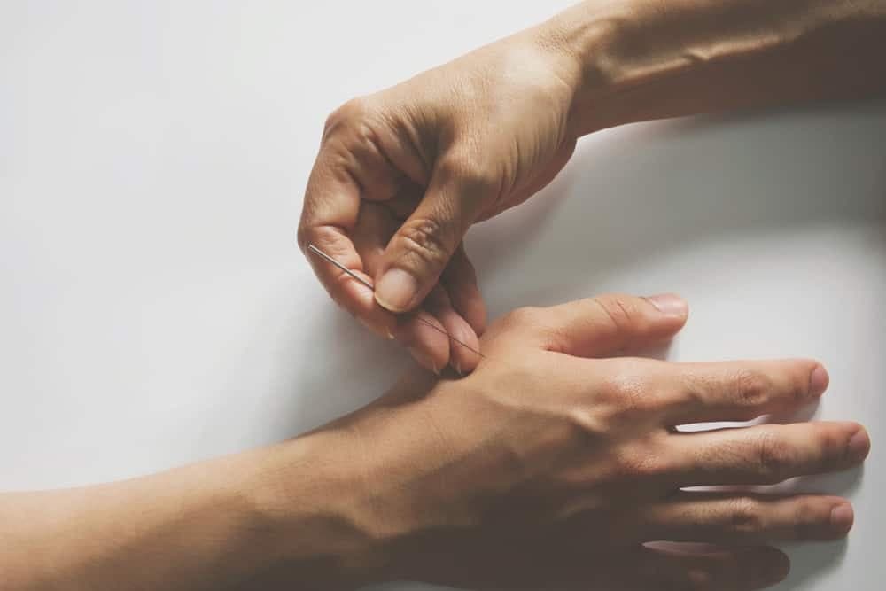 Châm cứu điều trị viêm khớp dạng thấp