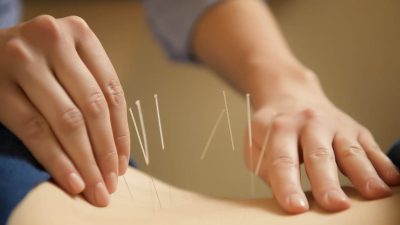 Châm cứu chữa viêm cột sống dính khớp