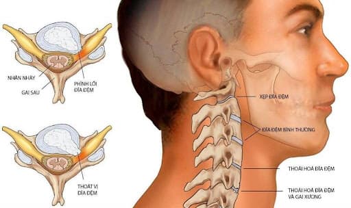 Bệnh thoát vị đĩa đệm đốt sống cổ có nguy hiểm không?
