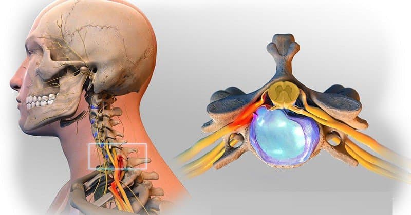 Nguyên nhân thoát vị đĩa đệm cột sống cổ