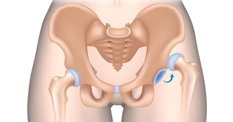 Dấu hiệu trật khớp háng