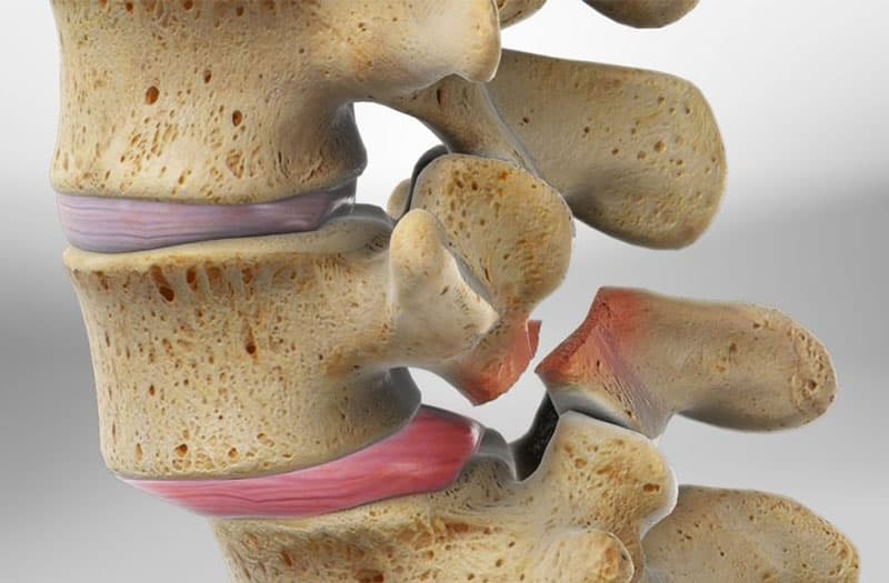 Nguyên nhân dẫn đến trượt cột sống