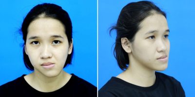 Cách nhận biết mặt lệch