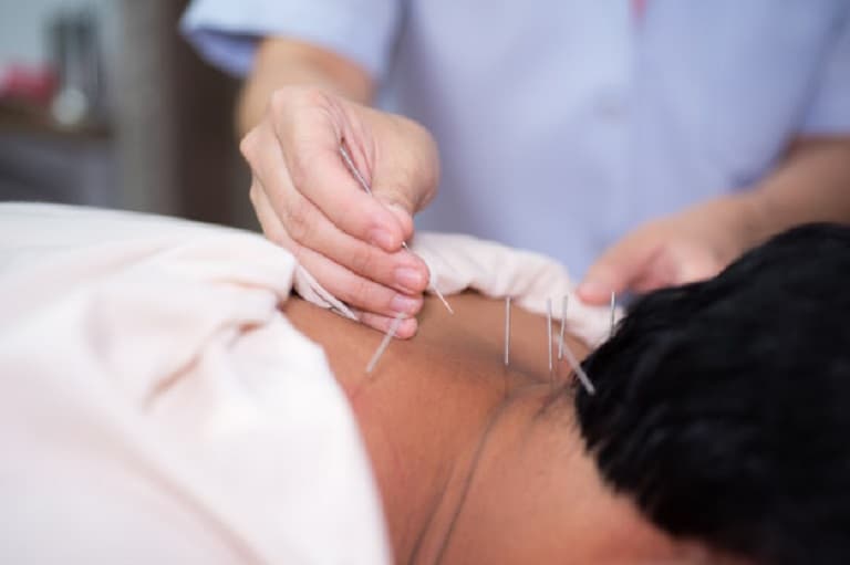 Châm cứu điều trị đau cứng cổ sau gáy