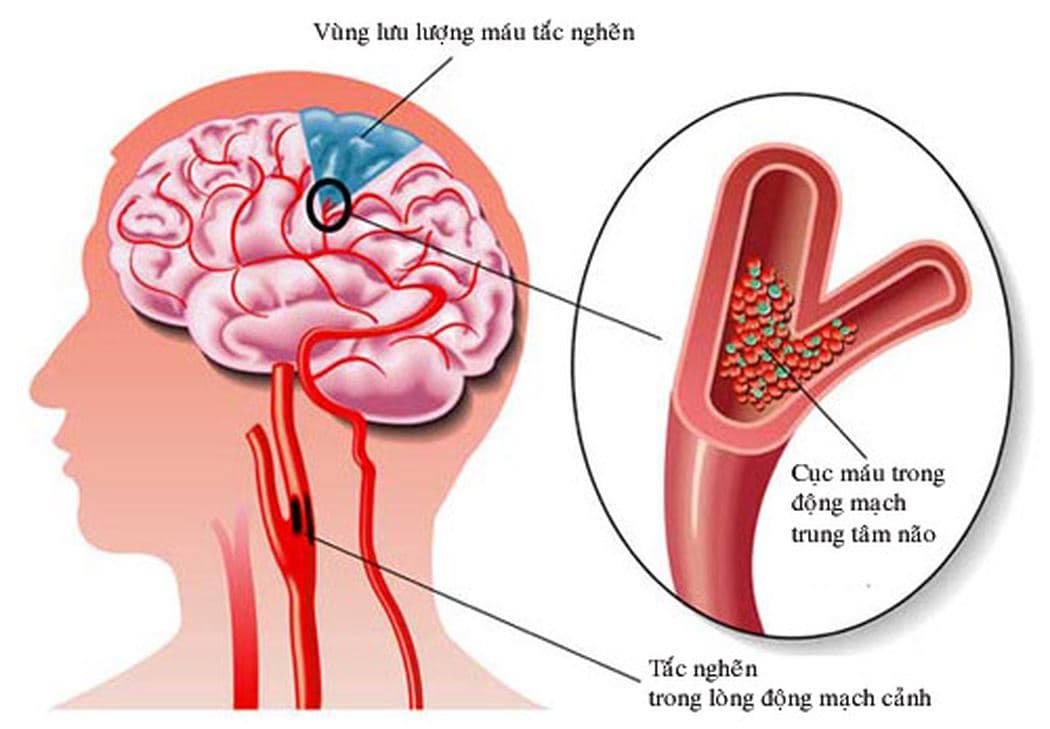 Thiểu năng tuần hoàn não