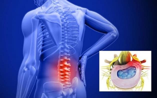 Khi cơn đau cấp tính nghiêm trọng