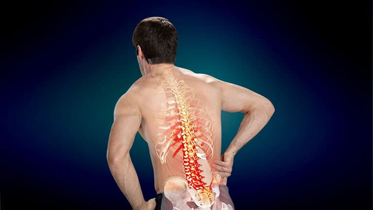 Đĩa đệm bị chèn ép nặng dẫn đến đau thần kinh tọa