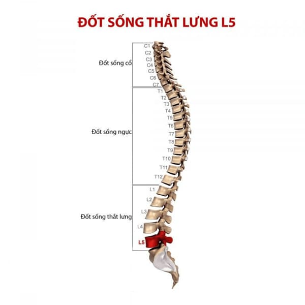 Thoát vị đĩa đệm L5 S1
