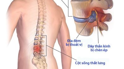 Triệu chứng Thoát vị đĩa đệm L5 S1