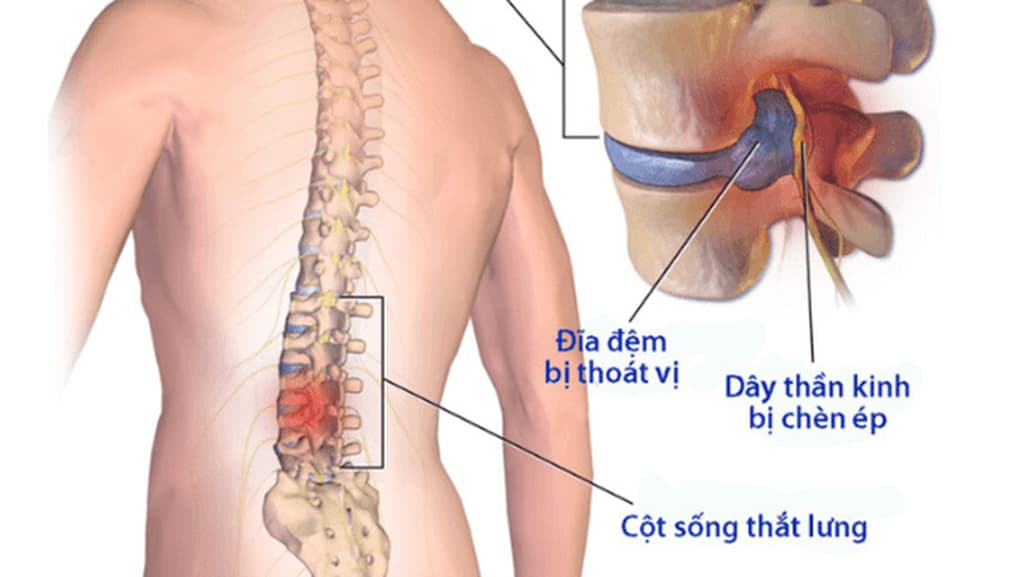 Triệu chứng Thoát vị đĩa đệm L5 S1