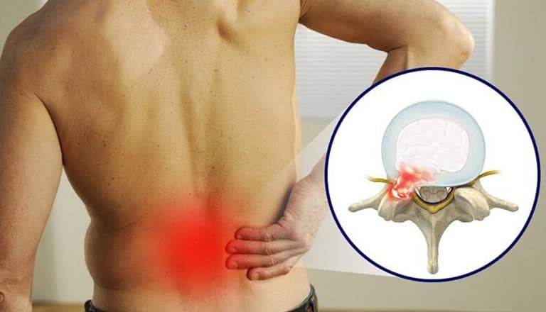 Nguyên nhân dẫn đến thoát vị đĩa đệm L5 S1
