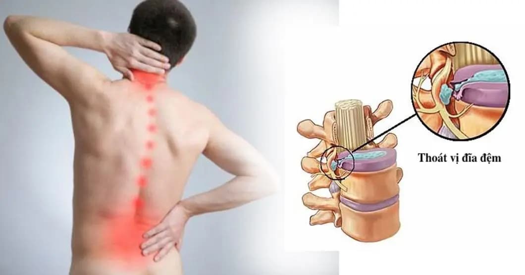 Nguyên nhân gây thoát vị đĩa đệm lưng