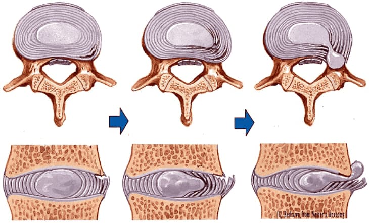 Thoát vị đĩa đệm nội xốp là gì?