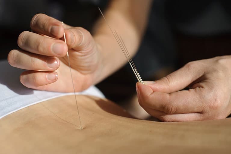 Điều trị xẹp đĩa đệm bằng đông y 