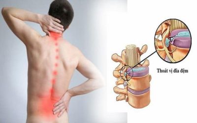 Nguyên nhân gây xẹp đĩa đệm