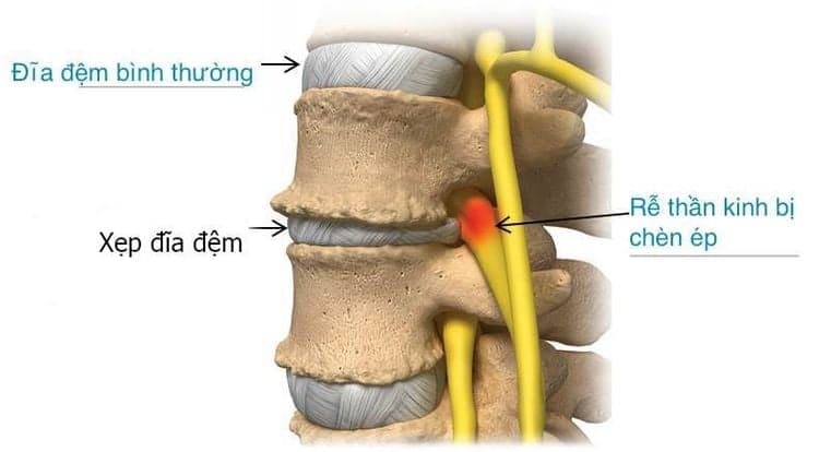 Xẹp đĩa đệm là gì?