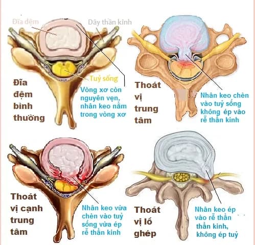 Thoát vị đĩa đệm thể trung tâm là gì?