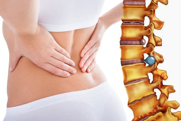 Nguyên nhân gây thoát vị đĩa đệm thể trung tâm