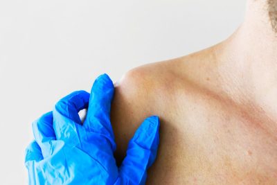 Cách điều trị xương đòn vai nhô cao do trật khớp cùng đòn