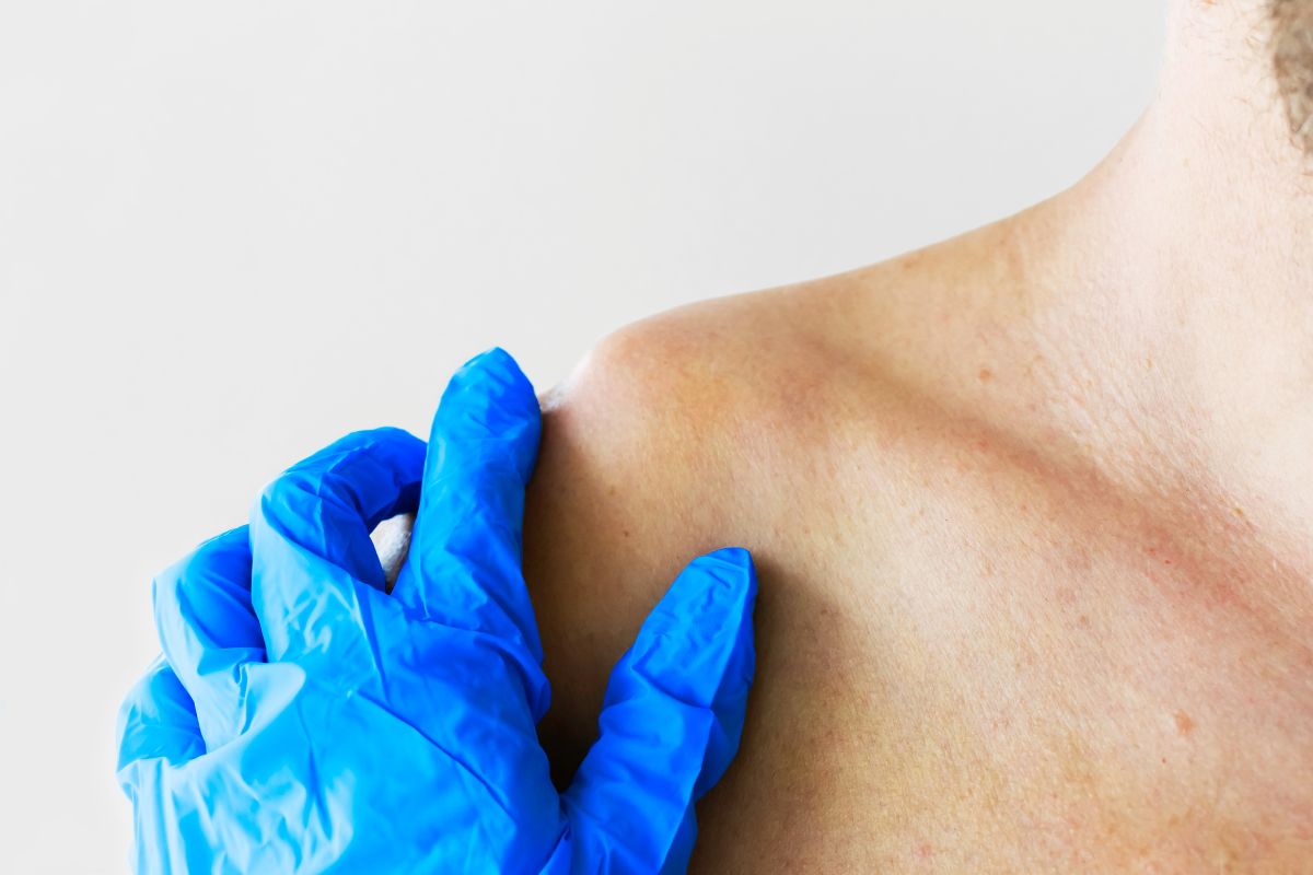 Cách điều trị xương đòn vai nhô cao do trật khớp cùng đòn