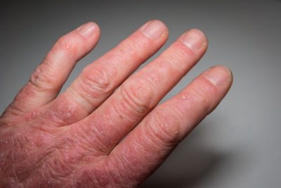 Nguyên nhân gây bệnh viêm khớp vảy nến