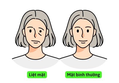 Bệnh liệt mặt ngoại biên (Bell's palsy)