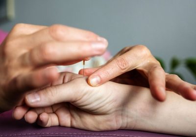 Châm cứu chữa tê tay