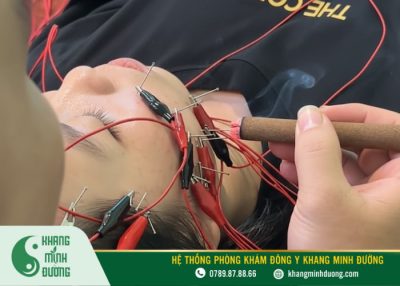 Liệu pháp châm cứu liệt dây thần kinh VII ngoại biên tại Khang Minh Đường 