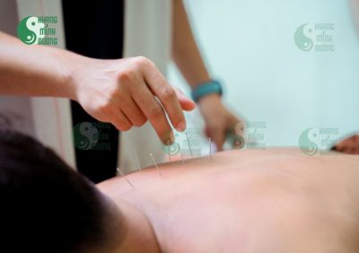 Châm cứu chữa đau lưng có thực sự hiệu quả không?