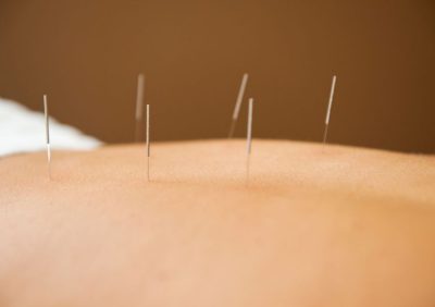 Châm Cứu Có Thực Sự Chữa Được Đau Thần Kinh Tọa Không?