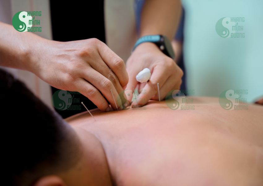 Châm cứu chữa gai cột sống