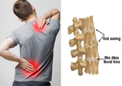 Gai Cột Sống Có Thể Điều Trị Không Phẫu Thuật Bằng Đông Y Không?