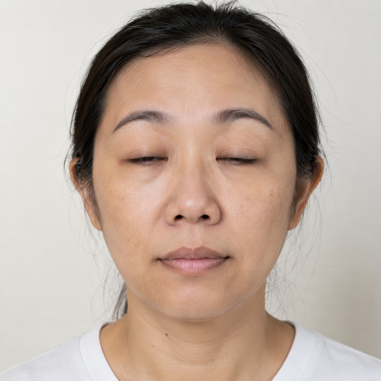 biểu hiện liệt mặt