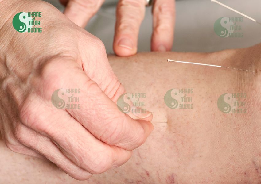 Châm cứu chữa thoái hóa khớp gối